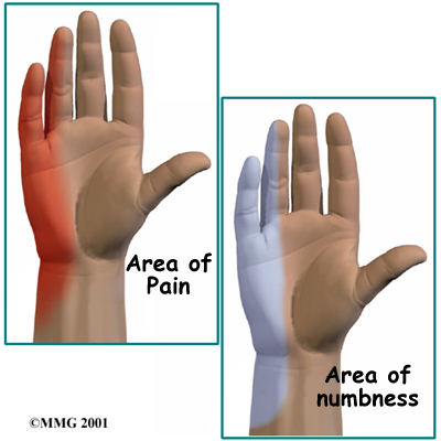 Ulnar Nerve Entrapment Cheshire  Cubital Tunnel Syndrome Stafford